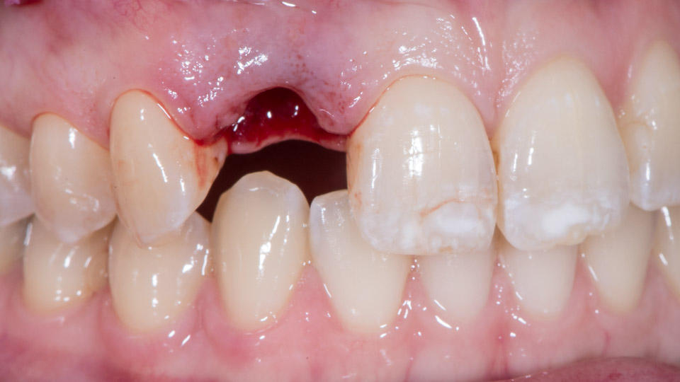 آسیب های تروماتیک دندان خارج شده